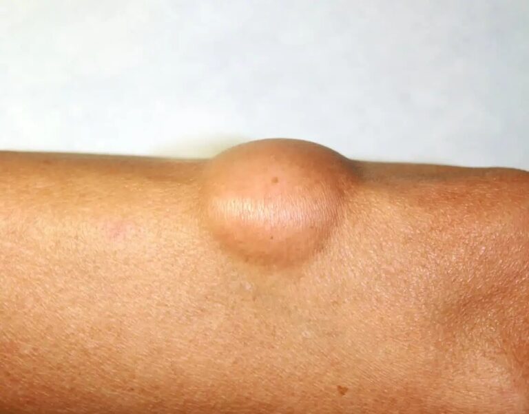 علاج الورم الشحمي في أبو ظبي