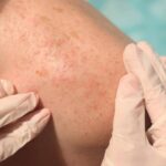 علاج الأمراض الجلدية في أبوظبي