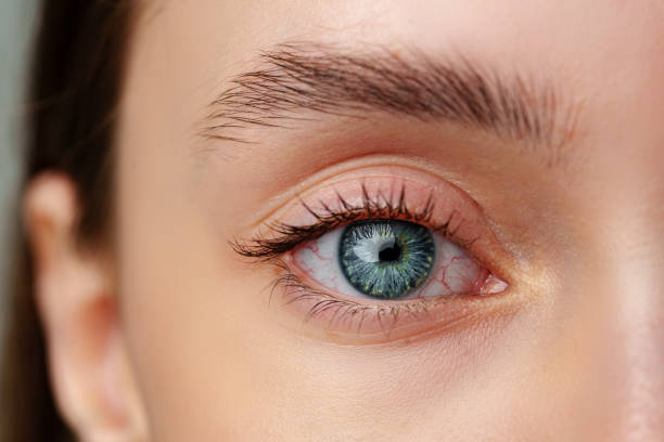 Can Eye Bag Removal Improve Facial Confidence