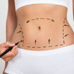 Can Liposuction Improve Body Contours Fast