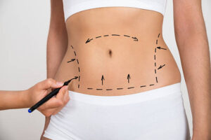 Can Liposuction Improve Body Contours Fast