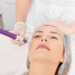 Can RF Microneedling Improve Stretch Marks Fast