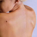 Can Skin Tag Removal Improve Skin Appearance