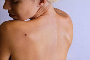 Can Skin Tag Removal Improve Skin Appearance