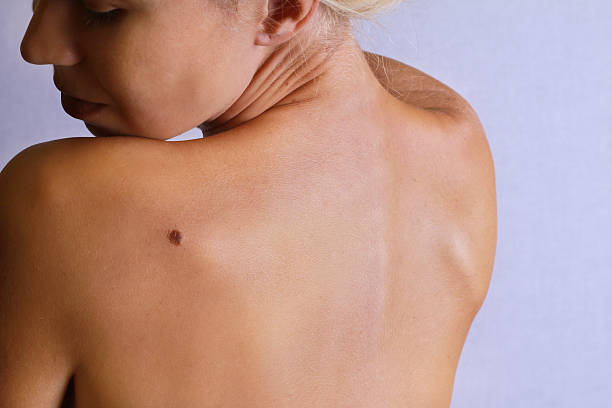 Can Skin Tag Removal Improve Skin Appearance