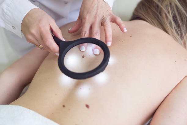 Can Wart Removal Stop Warts From Spreading Fast
