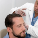 Direct Hair Implantation