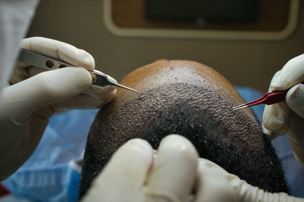 Does FUE Hair Transplant Work For Long Hair Goals Over Time