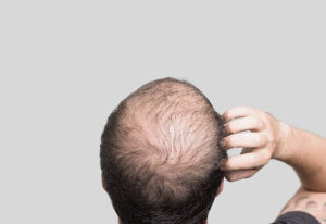 Does GFC Treatment for Hair Deliver Long-Term Results