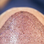 Does Hair Transplant Give Better Density In Thinning Areas
