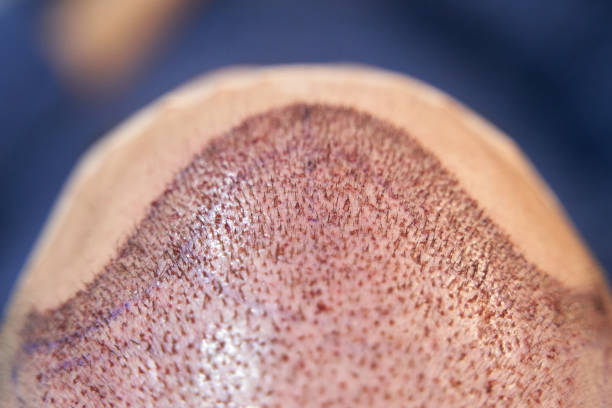 Does Hair Transplant Give Better Density In Thinning Areas