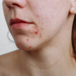 Does Laser Acne Scar treatment Work On Back Acne Scars