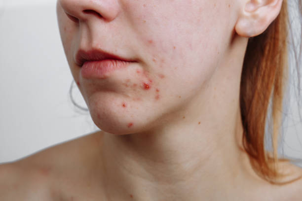 Does Laser Acne Scar treatment Work On Back Acne Scars