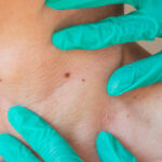 Does Mole Removal Support Better Skin Texture and Tone