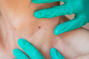 Does Mole Removal Support Better Skin Texture and Tone