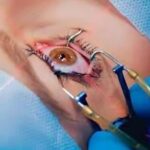 Femto LASIK Surgery in Delhi at Shreya Eye Centre using advanced bladeless laser technology for safe, precise vision correction and glass-free eyesight