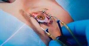 Femto LASIK Surgery in Delhi at Shreya Eye Centre using advanced bladeless laser technology for safe, precise vision correction and glass-free eyesight