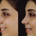 Rhinoplasty in Dubai