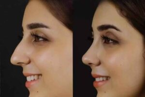 Rhinoplasty in Dubai