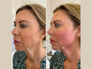 Best Plastic Surgeons in dubai Providing Affordable Endolift Options