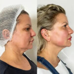 Best Doctors in dubai Delivering Skin Through Endolift Laser Technology