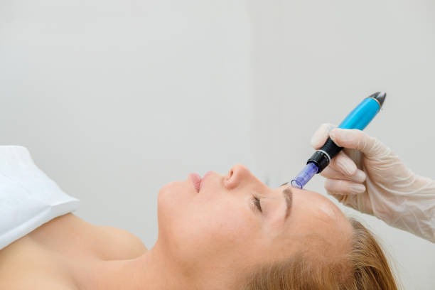 How Can RF Microneedling Enhance Skin Elasticity Naturally