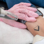 How Can You Tell If Laser Tattoo Removal Is Working Yet
