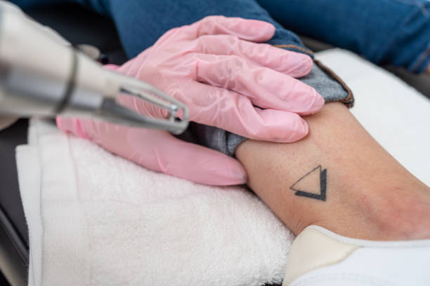 How Can You Tell If Laser Tattoo Removal Is Working Yet