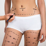 How Can You Tell If Liposuction Is Right For You