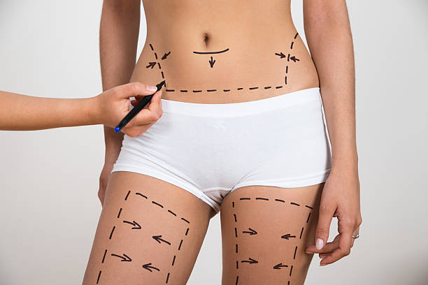 How Can You Tell If Liposuction Is Right For You