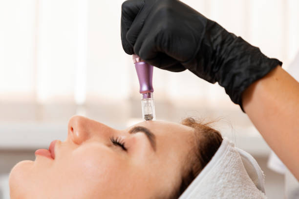 How Can microneedling Improve Overall Skin Health Naturally