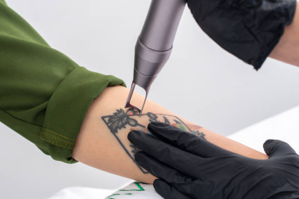 How Many Sessions Need for Tattoo Removal
