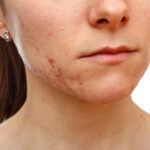 Is Acne Treatment The Right Move For Clearer Looking Skin