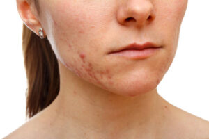 Is Acne Treatment The Right Move For Clearer Looking Skin
