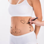 Is Body Jet Liposuction a Good Start for Body Transformation