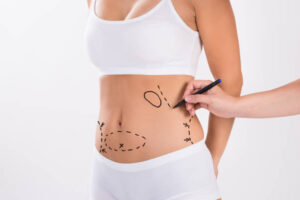 Is Body Jet Liposuction a Good Start for Body Transformation
