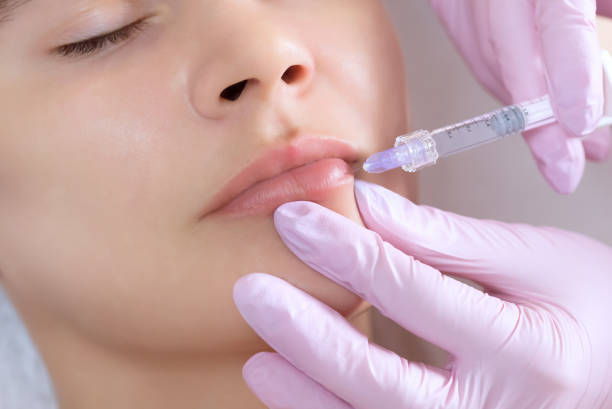 Is Russian Lip Fillers Treatment Right for Your Face Shape