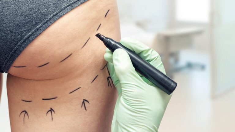 Non-Surgical BBL