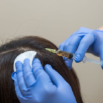 PRP-Vs-PRF-For-Hair-Loss-Which-O