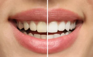 Teeth Whitening Hayward Wisconsin