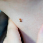 What Are the Benefits of Professional Skin Tag Removal