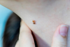 What Are the Benefits of Professional Skin Tag Removal