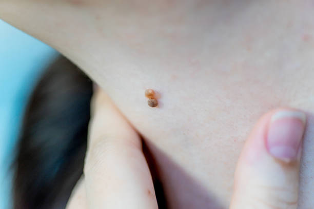 What Are the Benefits of Professional Skin Tag Removal