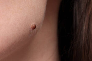 What Are the Most Trusted Wart Removal Treatments