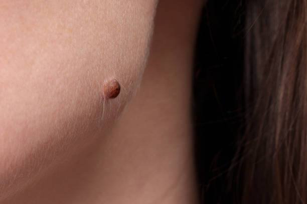 What Are the Most Trusted Wart Removal Treatments