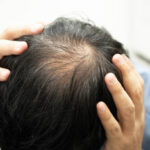 What Hair Loss Treatment Should You Use for Hair Regrowth