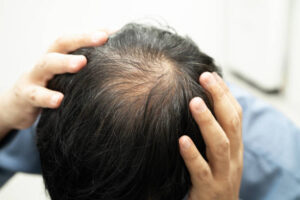 What Hair Loss Treatment Should You Use for Hair Regrowth