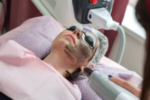 What Laser Carbon Peel Benefits Help Achieve Youthful Skin