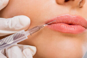 What Lip Filler Treatments Offer the Most Natural Finish