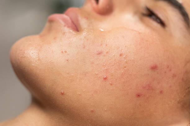Why Is Laser Acne Scar Treatment So Popular